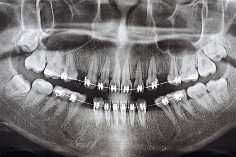 Orthopantomography x-ray stock image. Image of dentist - 169816513