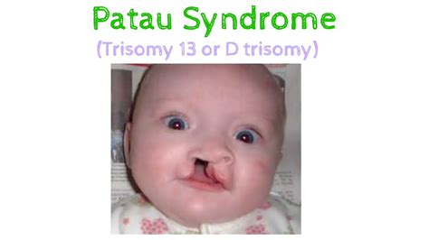 Trisomy 13 (Patau Syndrome): Symptoms, Causes Outlook, 51% OFF