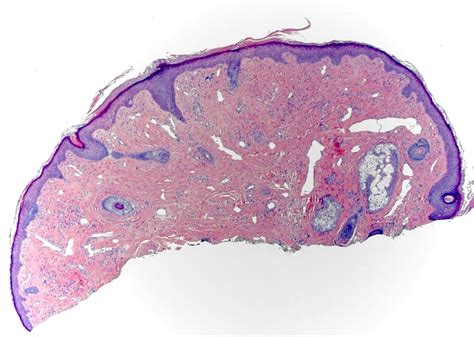 Fibrous Papule Histology