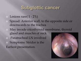 CA larynx Presentation - diag. & treatment | PPT | Free Download