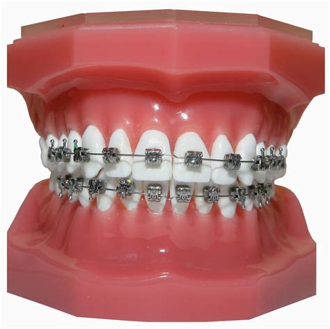 Types Of Orthodontic Braces