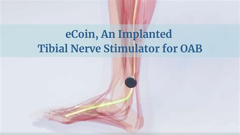 eCoin, An Implanted Tibial Nerve Stimulator for OAB ⋆