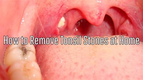 Tonsil Stones Diagram