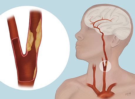 Carotid Arteries In Neck - Carotid Artery Endarterectomy Western New York Urology Associates Llc ...