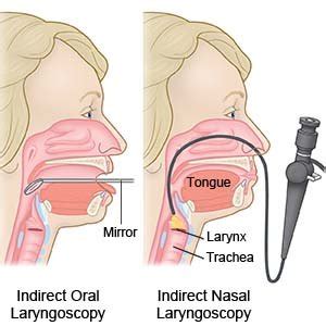 Laryngoscopy - What You Need to Know