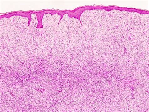 Dermatofibrosarcoma protuberans - Alchetron, the free social encyclopedia