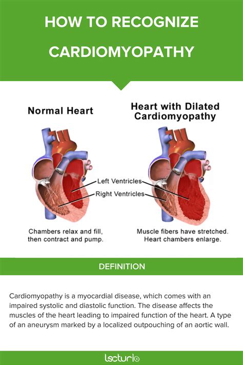 Overview of Cardiomyopathies | Concise Medical Knowledge | Patient care ...