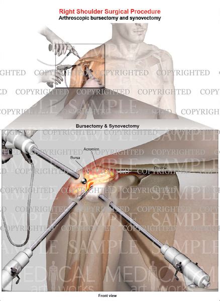 Right shoulder arthroscopic repair - Bursectomy - Synovectomy - Male — Medical Art Works