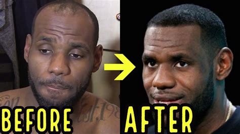 Lebron James Hair Transplant | Sapphire Hair Clinic