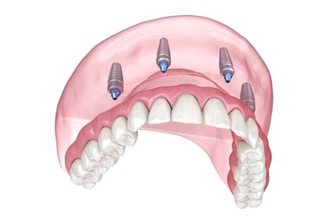 All-on-4® vs. Dental Bridges vs. Traditional Dentures - Clear Creek ...