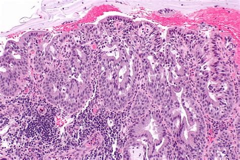 Microglandular hyperplasia of the uterine cervix - Libre Pathology