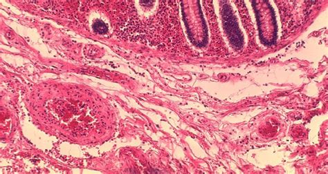 What is ischemic bowel disease?