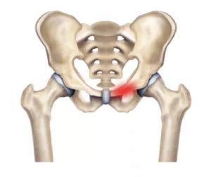 Pubic ramus stress fracture - City Hospital, Dehradun