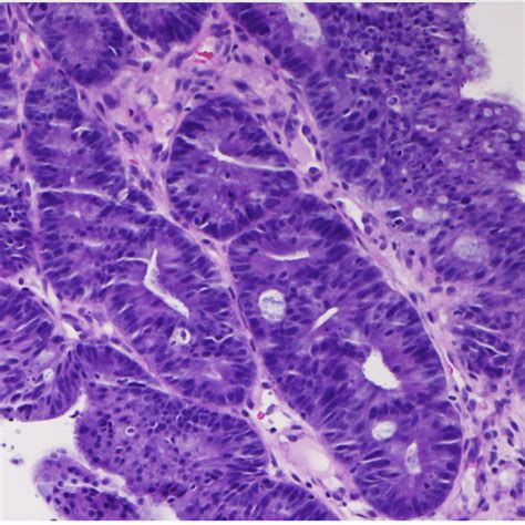 Fronds of villous adenoma, H&E 10X. | Download Scientific Diagram