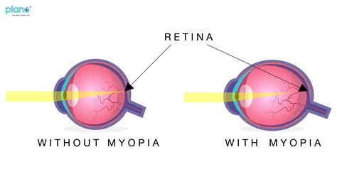 Myopia (Nearsightedness or Short-sightedness): A Global Epidemic