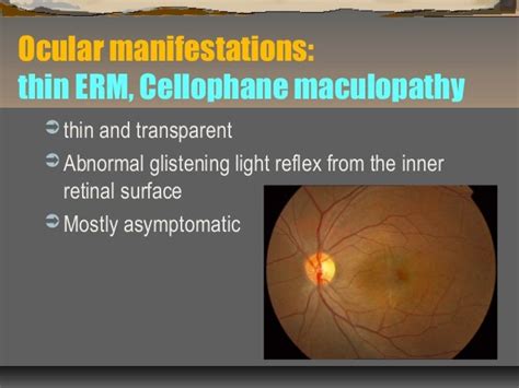 NW2010 Epiretinal membrane