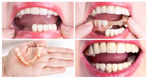 Partial Denture Before And After