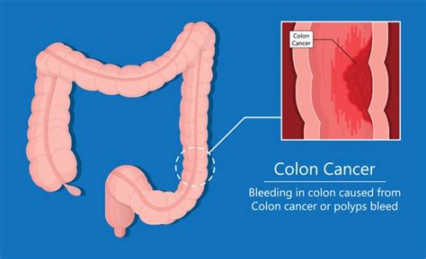 Colon Cancer Screening Test: Over 93 Royalty-Free Licensable Stock Illustrations & Drawings ...