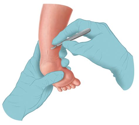 Emma Scheltema Illustration - Clubfoot Tenotomy for Starship Child Health