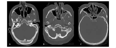 Sinus opacification grades. Axial CT scan images demonstrate normally ...