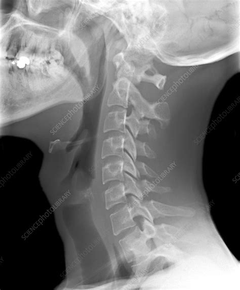 Normal neck, X-ray - Stock Image - C010/3497 - Science Photo Library