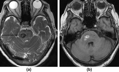 The trigeminal nerve: An illustrated review of its imaging anatomy and ...