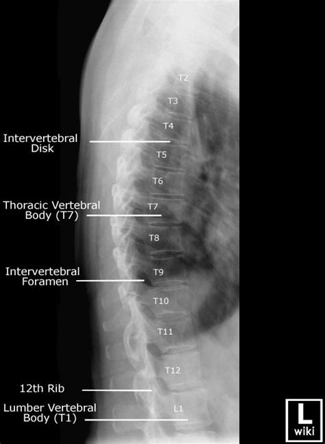 Thoracic Spine radiographic Anatomy - wikiRadiography | Radiology ...