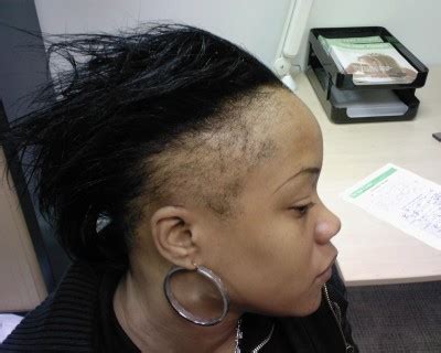 How to Reverse Traction Alopecia