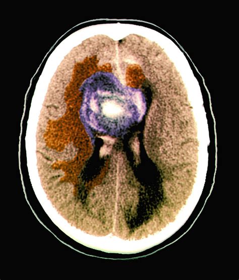 Gliomas Network With Normal Brain Cells To Grow Faster : Shots - Health News : NPR