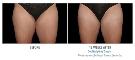 CoolSculpting For Slimming Inner & Outer Thighs