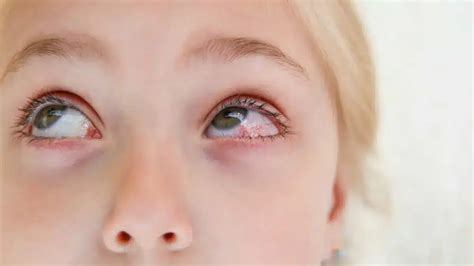 Bacterial Eye Infections: Symptoms, Types, and Treatments