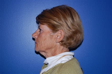 Facelifts & Rhytidectomy in Syracuse, NY: Syracuse Plastic Surgery