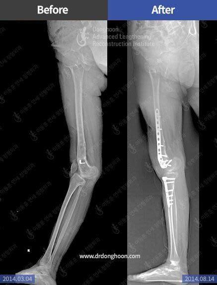 Genu Recurvatum – Limb Lengthening & Complex Reconstruction Service: Korea | DALRI