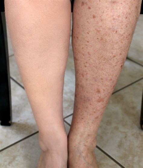 The Best Cover Up Makeup For Varicose Veins - Mugeek Vidalondon