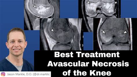 Avascular Necrosis Knee Treatment