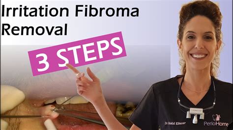 Irritation Fibroma Removal in 3 Steps - YouTube