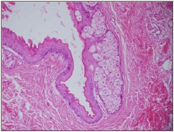 Steatocystoma Multiplex Histology