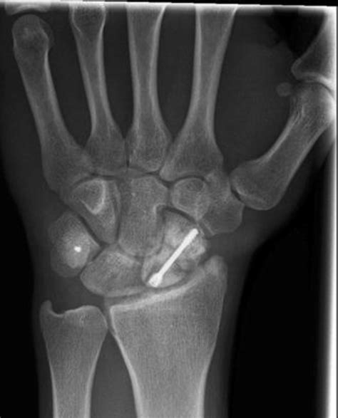 Scaphoid Fracture X Ray Views