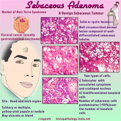 Pathology Sebaceous Adenoma | Pathology, Medical mnemonics, Medicine notes