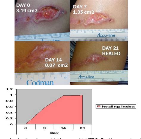 Figure 3 from MOISTURE AND WOUND HEALING | Semantic Scholar