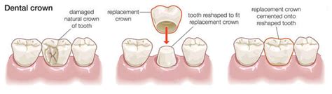 Dental Crowns, Bridges and Veneers - Budi Dental