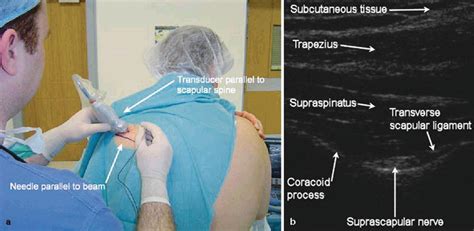 Suprascapular Nerve Block | Radiology Key