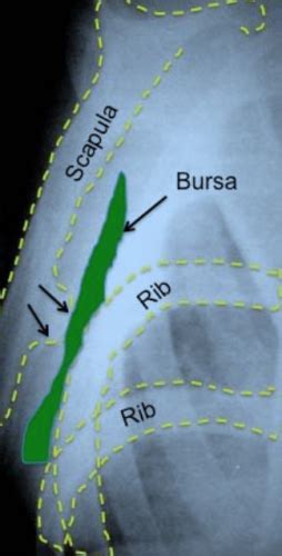 Boston Shoulder Institute – Scapulothoracic-Bursitis4