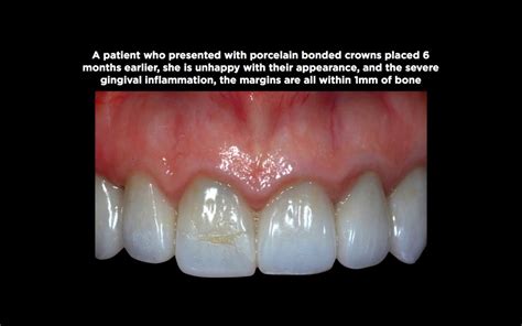 A Comprehensive Guide To Biologic Width - Spear Education