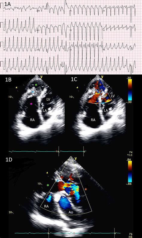 Adult Double-Chambered Right Ventricle Associated With Ventricular ...