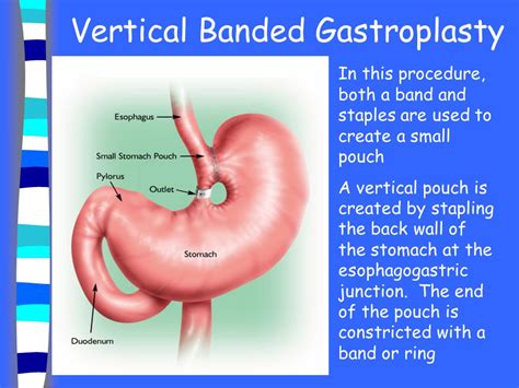 Vertical Banded Gastroplasty Before And After