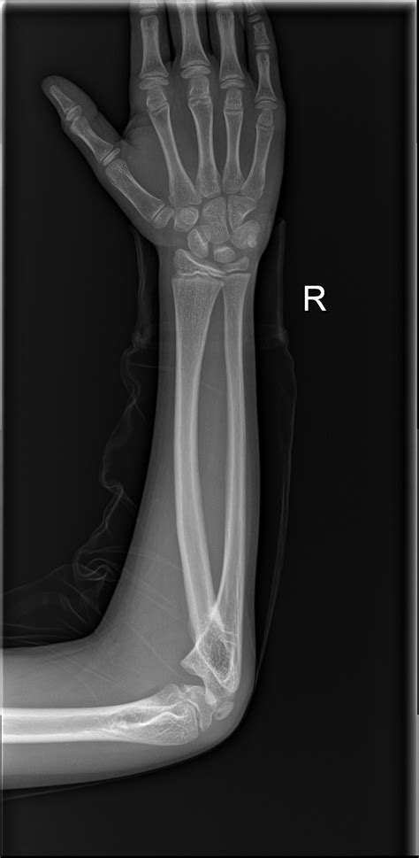 Proximal radioulnar synostosis | Image | Radiopaedia.org