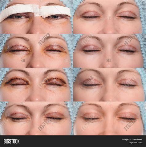 Blepharoplasty Upper Image & Photo (Free Trial) | Bigstock