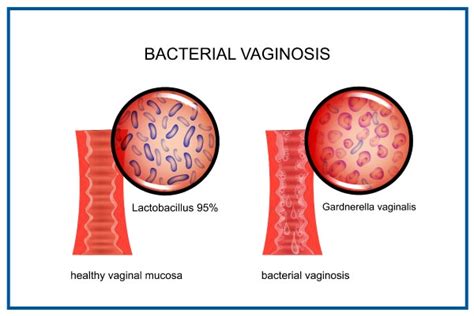 Bacterial Vaginosis: Prevention, Coping, And Living Well