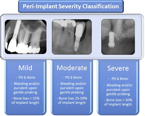 Is Peri-Implantitis Curable? - Dental Clinics